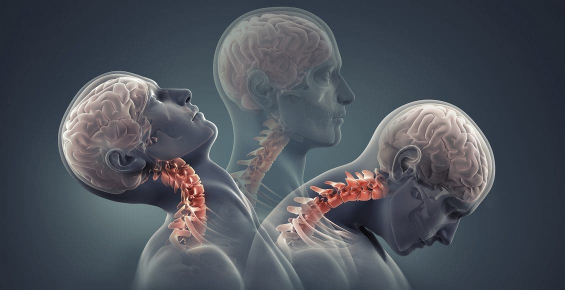 Whiplash Caused by Acceleration and Deceleration - El Paso Chiropractor