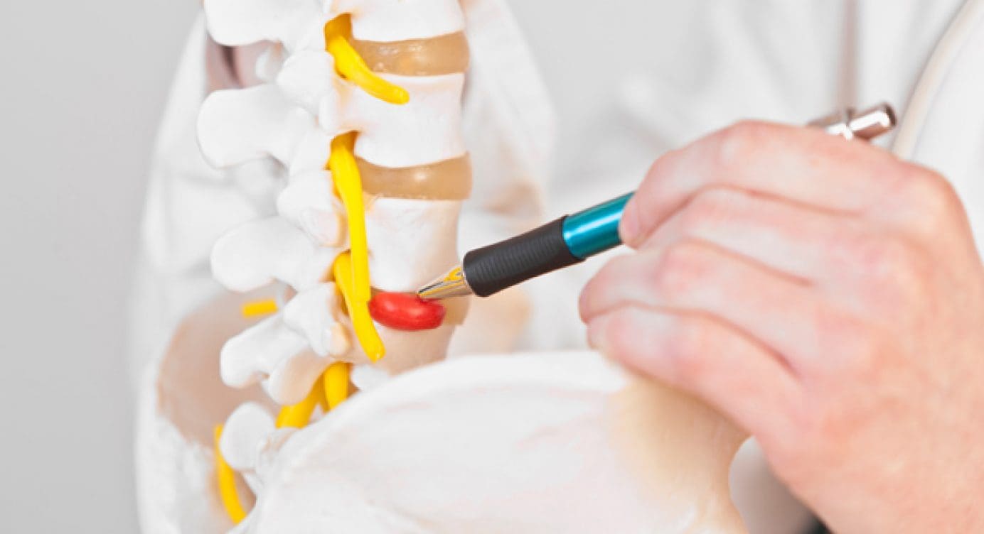 Scientific Chiropractor: Herniated Disc Signs and Symptoms