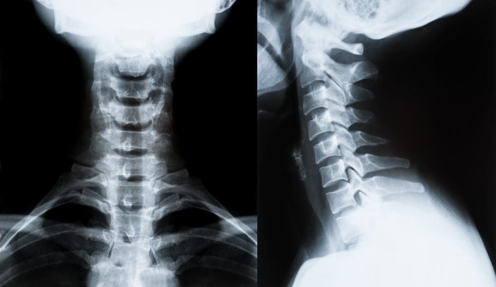 Whiplash Chiropractor: Loss of Cervical Lordosis - El Paso Chiropractor