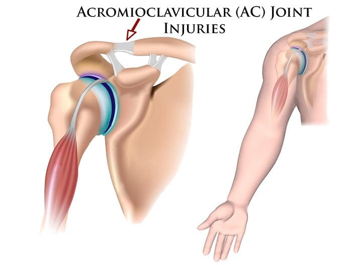 chiropractic care for acromioclavicular pain, el paso, tx.