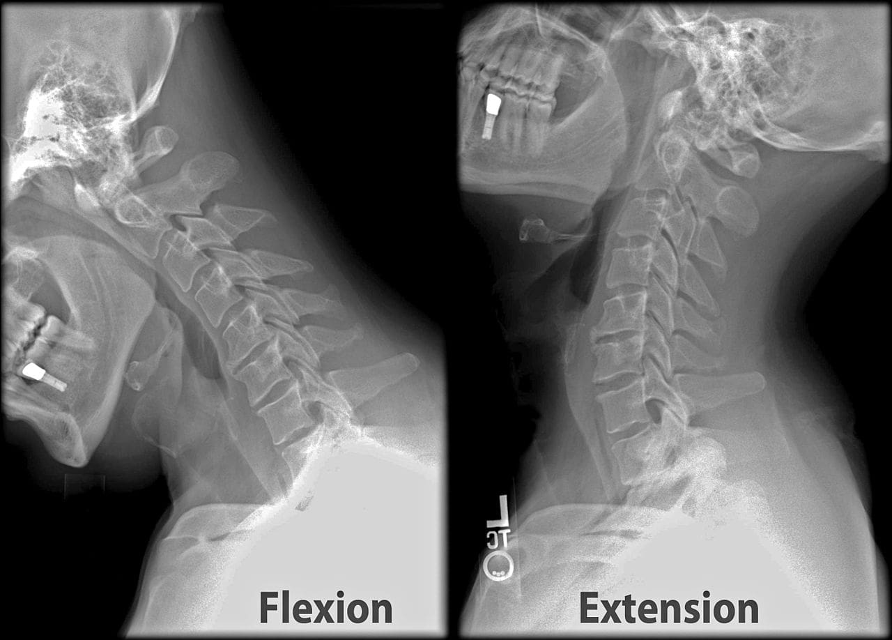 Cervical X-Ray Flexion Extension