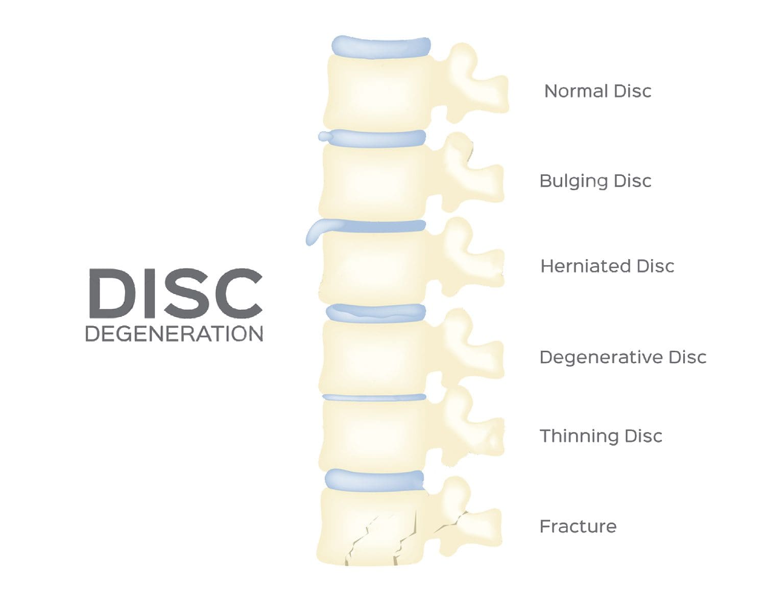 chiropractor spine-disc-degeneration-vector-back-bone-organ-anatomy