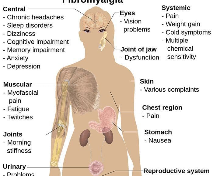fibromyalgia syndrome