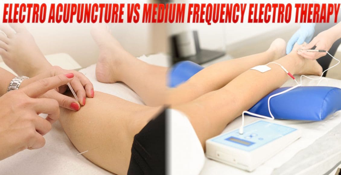 Electroacupuncture vs. Medium-Frequency Electrotherapy for Sciatica