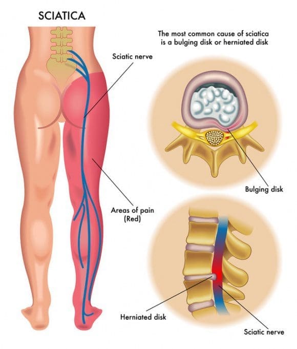 sciatica cause