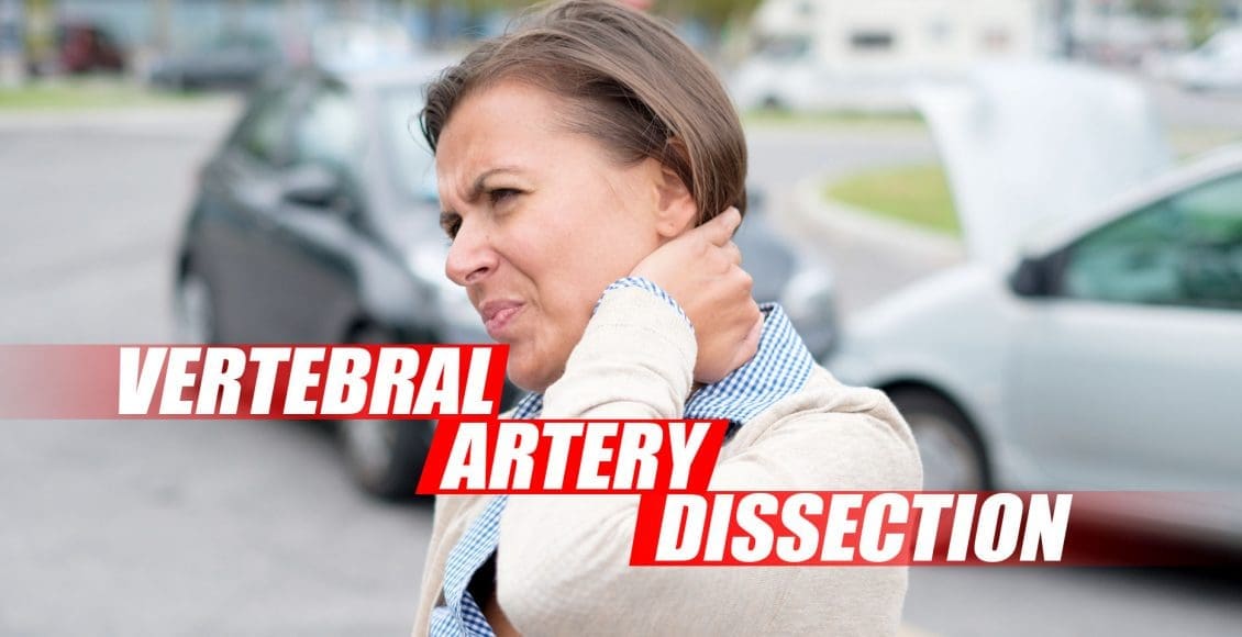 Vertebral Artery Dissection Found During Chiropractic Examination Cover Image