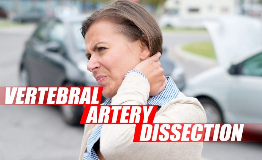 Vertebral Artery Dissection Found During Chiropractic Examination Cover Image
