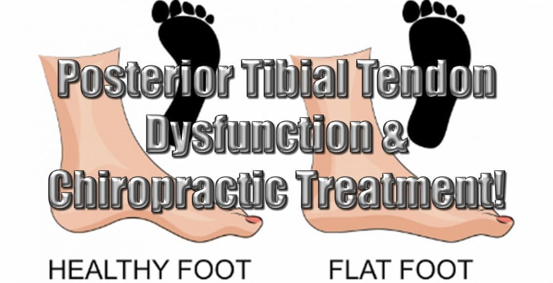 posterior tibial tendon dysfunction el paso tx.