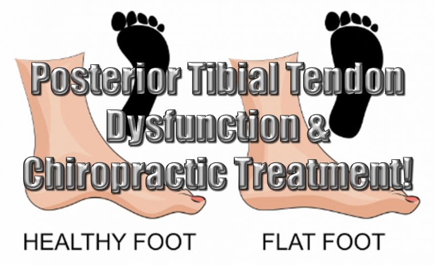 posterior tibial tendon dysfunction el paso tx.