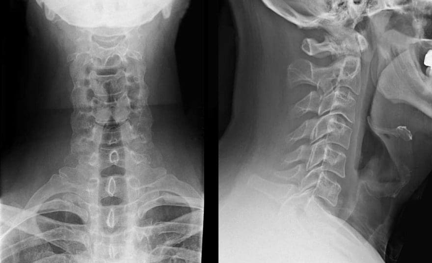 Cervical Spine Radiographs in the Trauma Patient | El Paso, TX Chiropractor