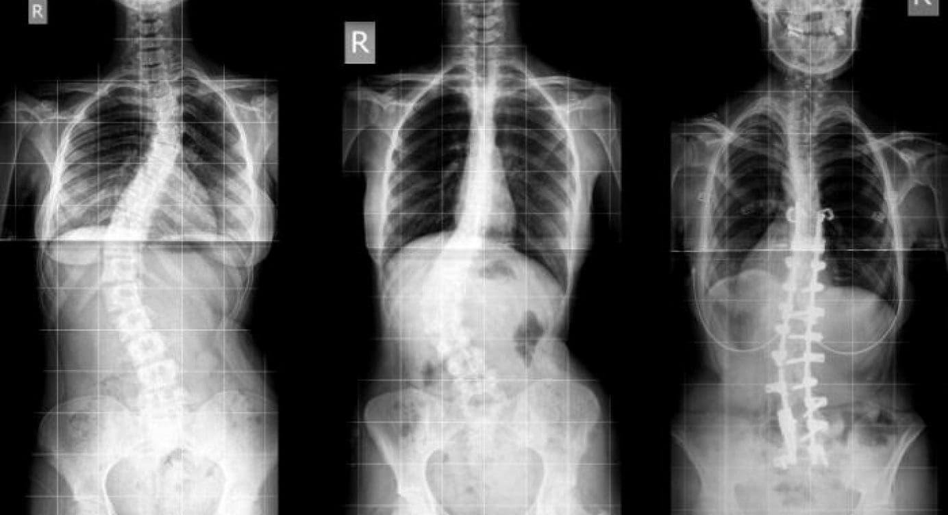 Imaging Diagnostics of Abnormalities of the Spine