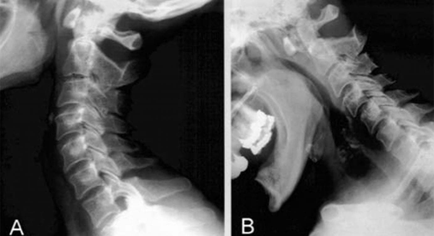 Imaging the Spine in Arthritis: a Pictorial Review