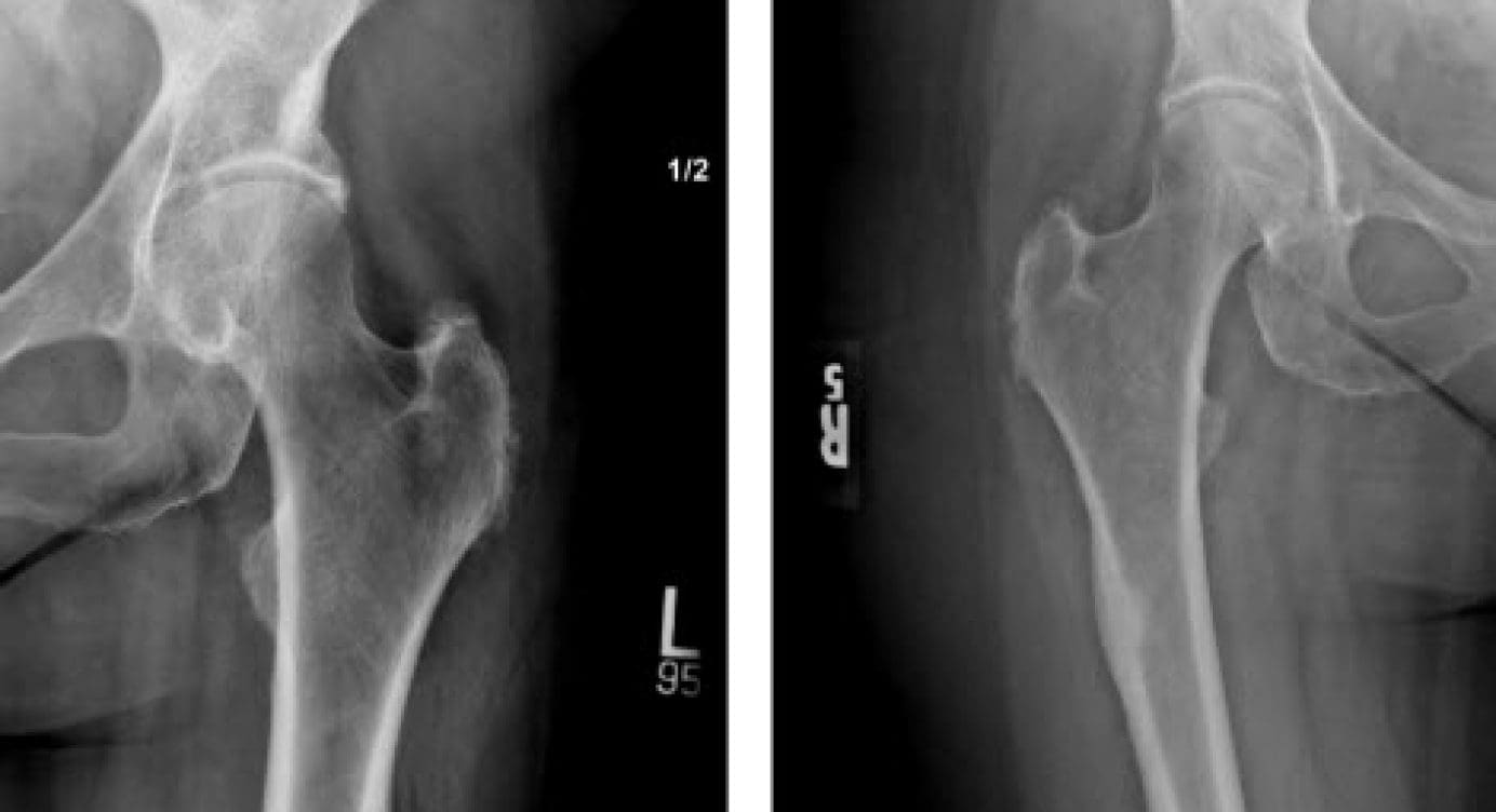 Bisphosphonate-Related Proximal Femoral Fractures