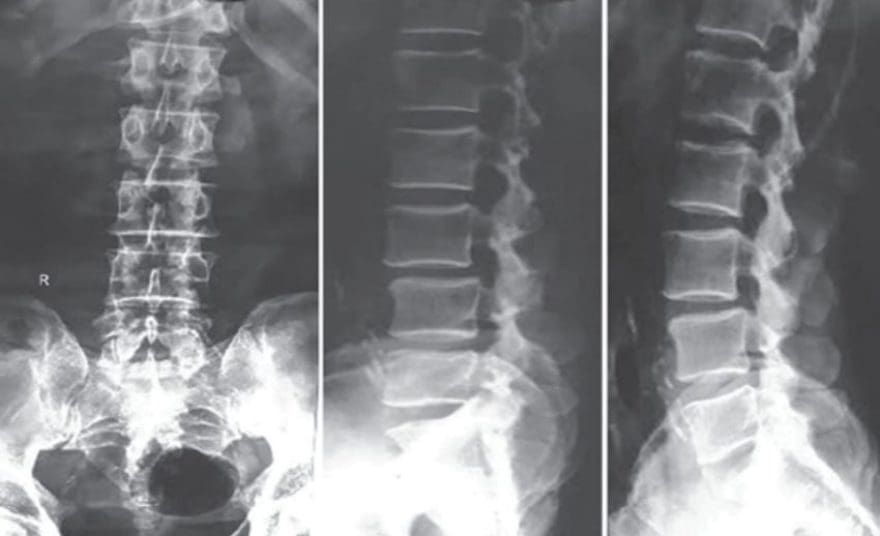 Classifying Spondylolisthesis | El Paso, TX Chiropractor
