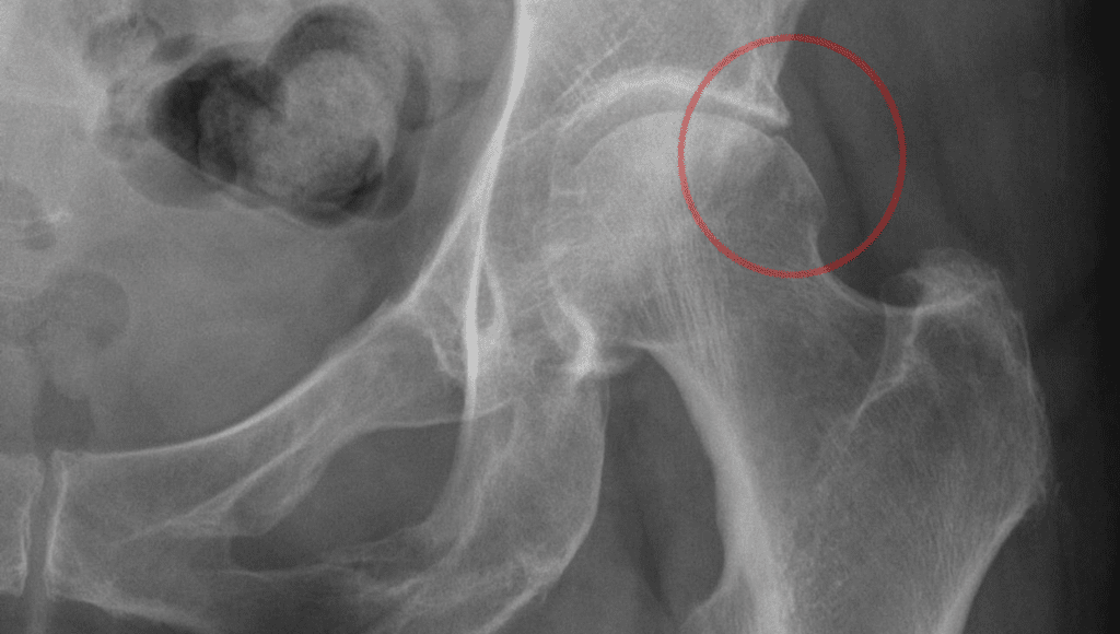 Femoroacetabular Impingement | El Paso, TX Chiropractor