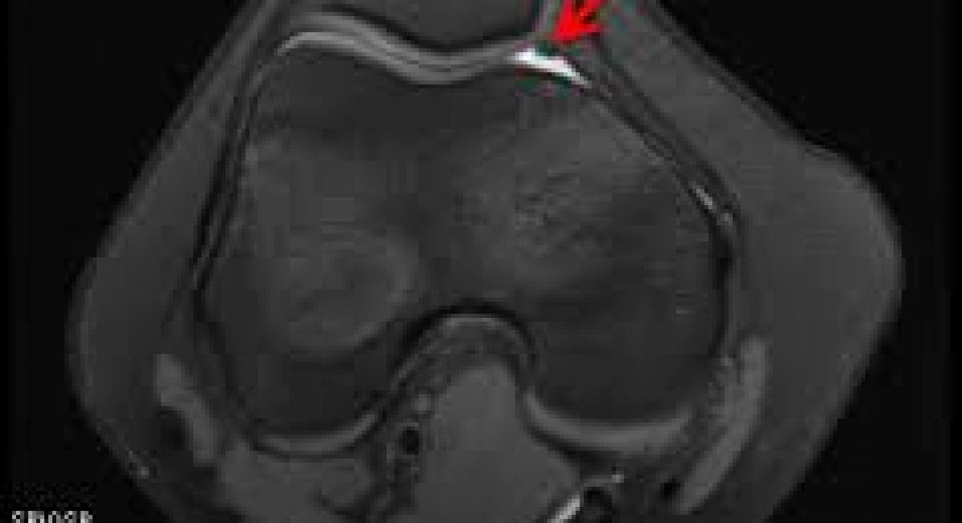 What is Knee Plica Syndrome?