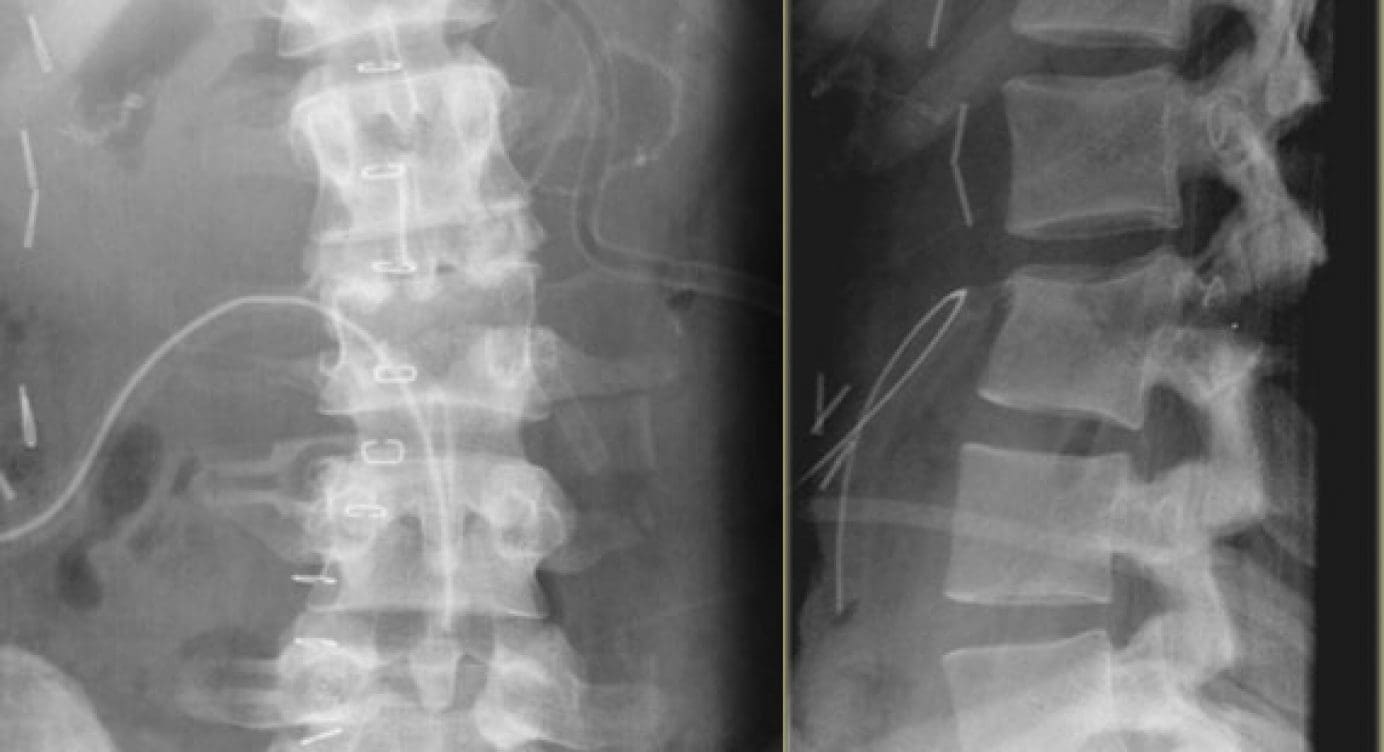 Spine Trauma Imaging Diagnostics Evaluation