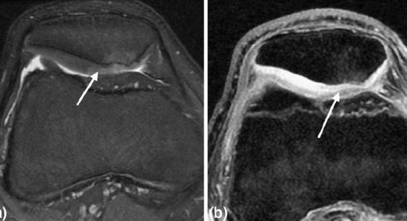 What is Chondromalacia Patellae?