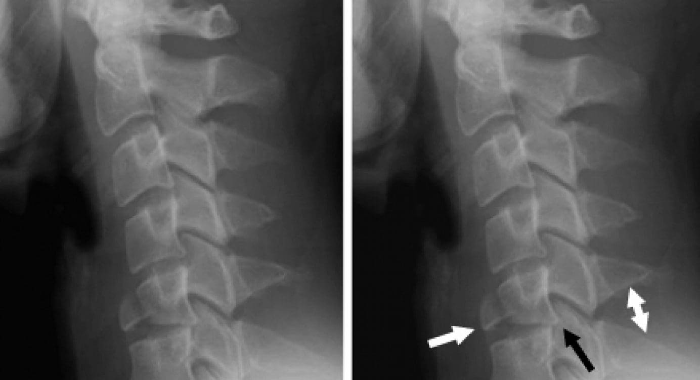 Imaging Diagnostics for Flexion Teardrop Fractures