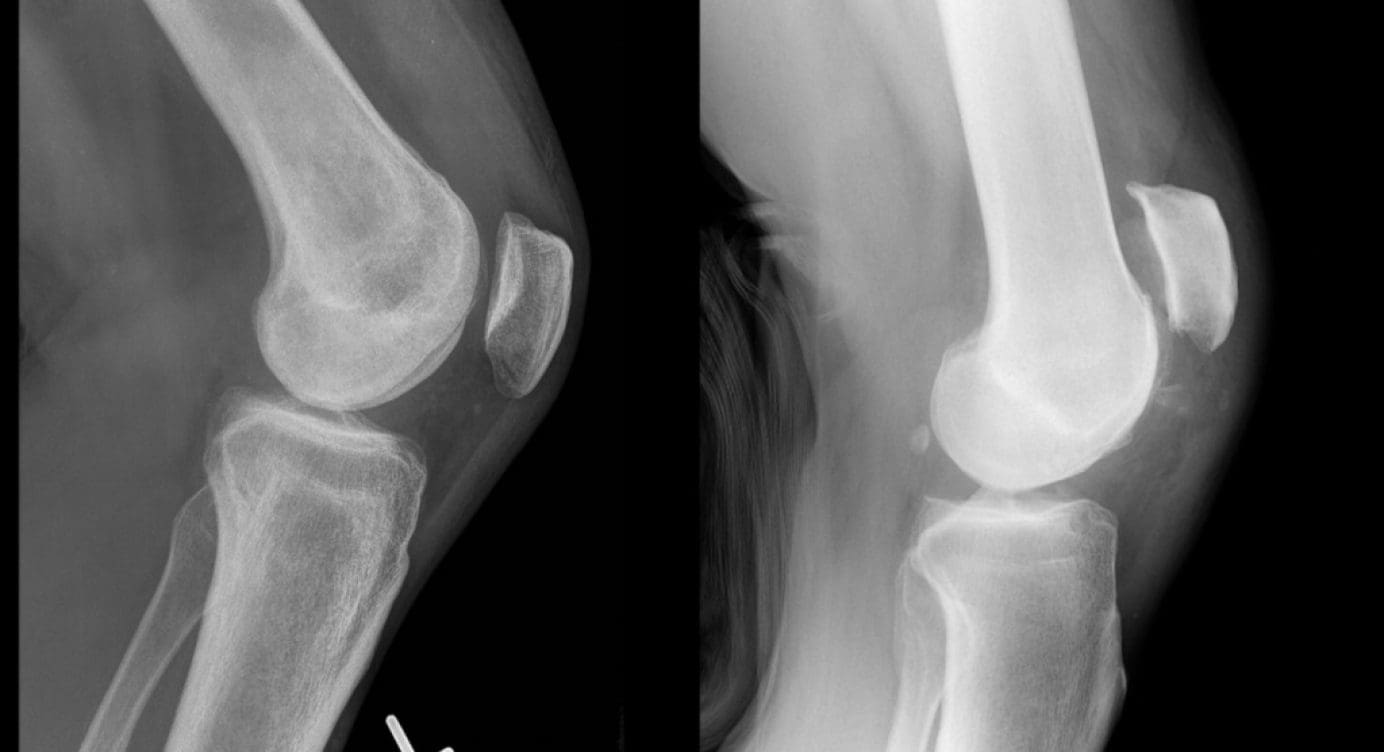 What is a Quadriceps Tendon Rupture?