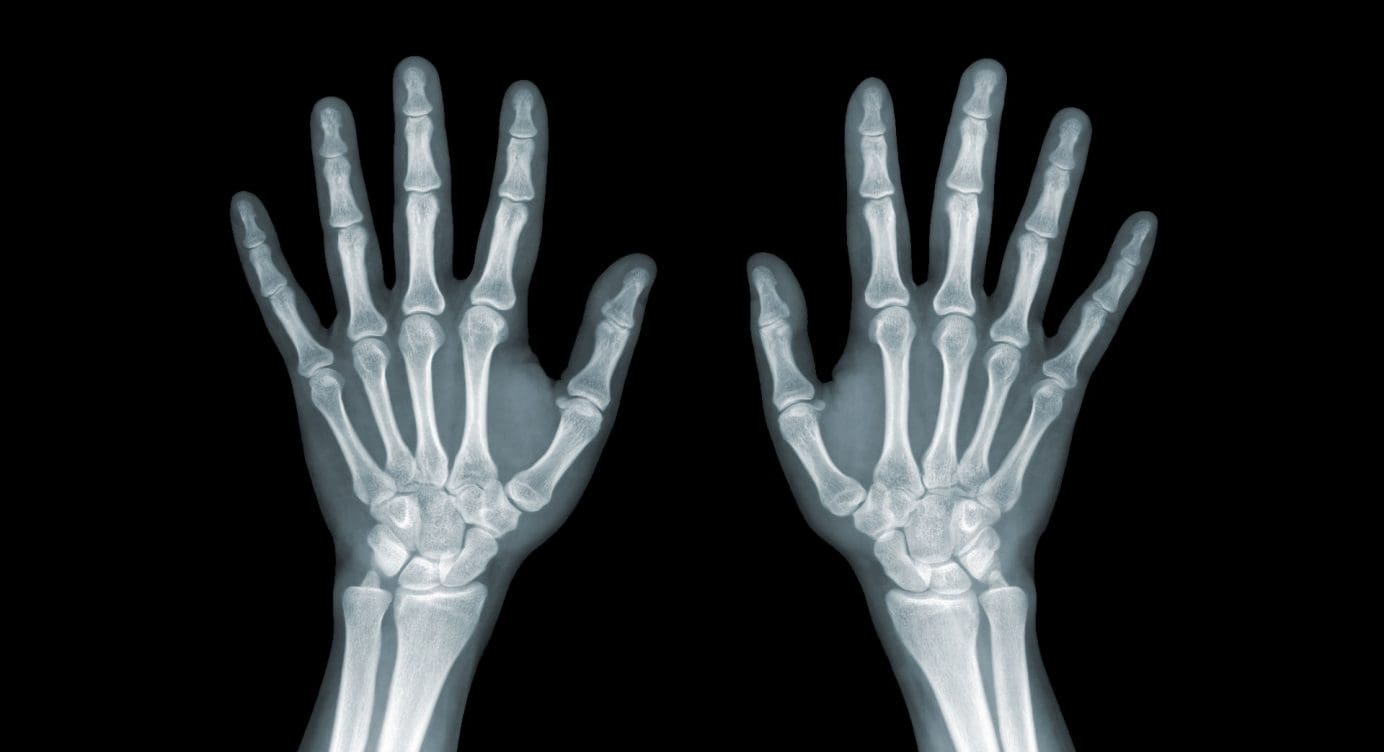 Wrist/Hand Arthritis And Trauma: Diagnostic Imaging | El Paso, TX.