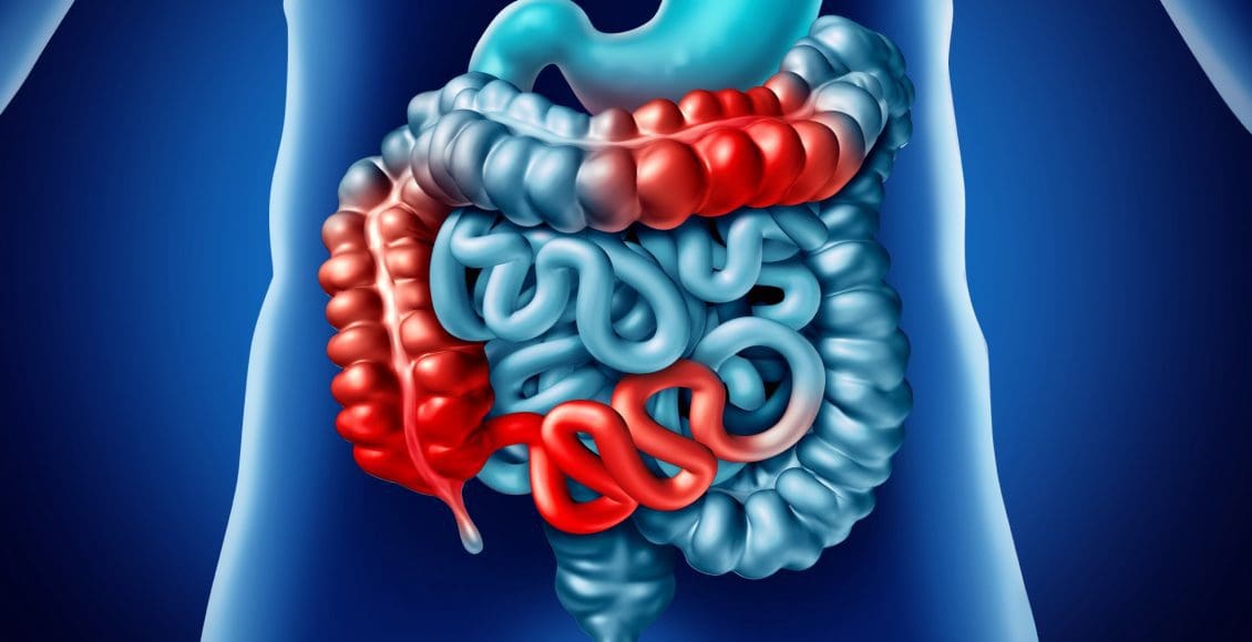 What is Crohn's Disease? An Overview | El Paso, TX Chiropractor