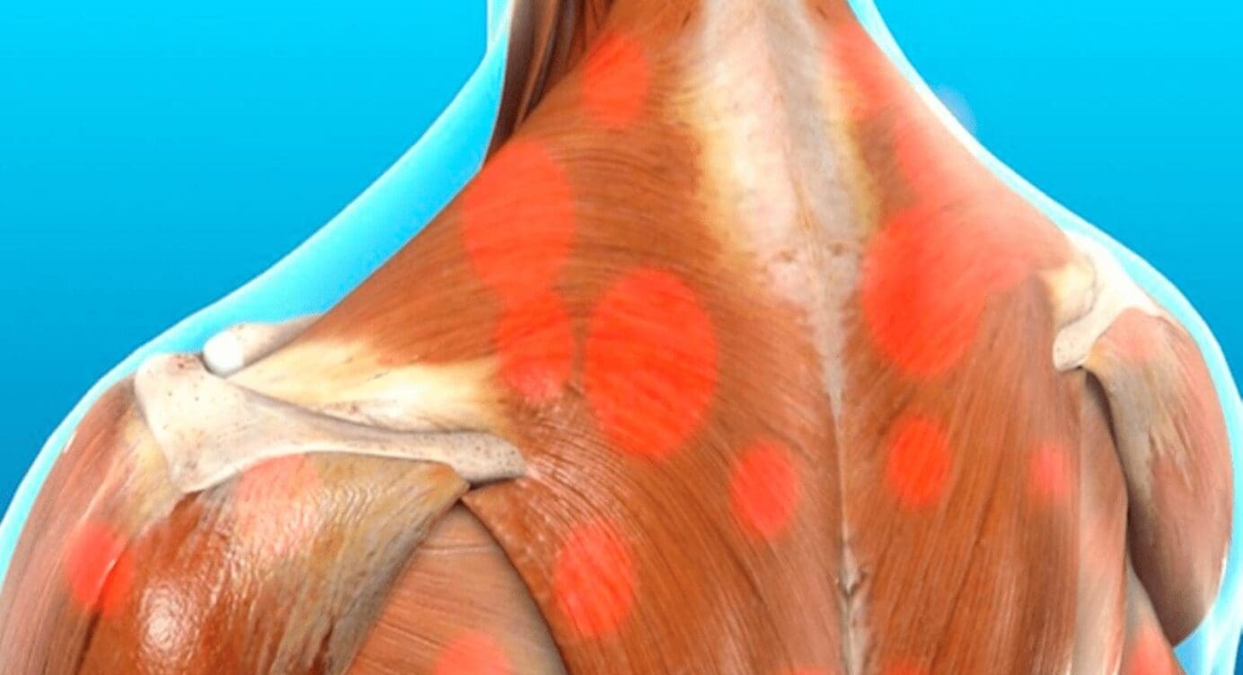 Myofascial Trigger Pain Affecting The Trapezius Muscle