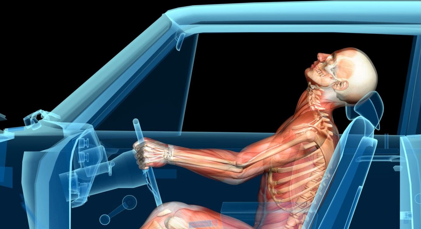 Whiplash and Achilles Tendinosis: Auto Accidents Impact