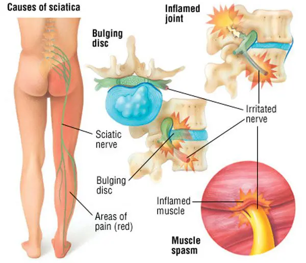Evidence-based Sciatica Treatment and Care Options