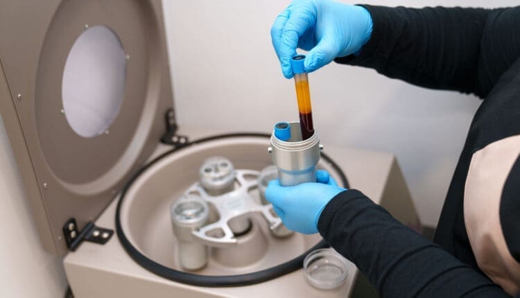 Precision Platelet-Rich Plasma in Modern Medicine