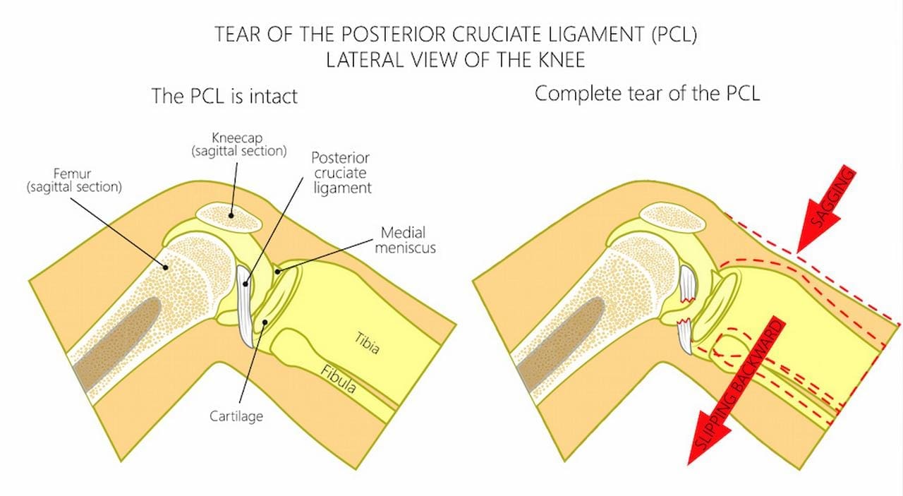 Dashboard Knee Injuries and PCL Tears Treatment Options